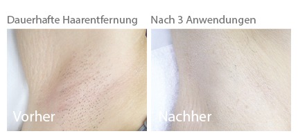 Haarentfernung Chemnitz Dauerhaft Mit Laser Ipl Und Shr