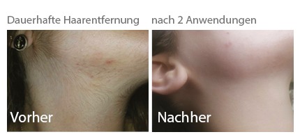 Haarentfernung Chemnitz Dauerhaft Mit Laser Ipl Und Shr