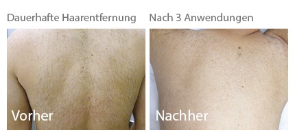 dauerhafte haarentfernung ergegnisse, dauerhafte haarentfernung erfahrungen, dauerhafte haarentfernung vorher nachher, preise dauerhafte haarentfernung, haarentfernung laser, haarentfernung ipl, enthaarung, enthaarung laser, enthaarung ipl